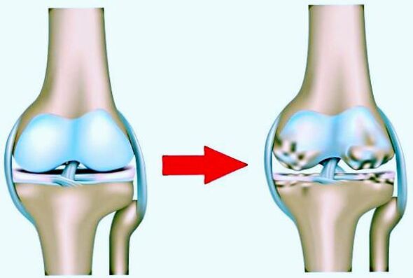 Articulación de la rodilla normal y afectada por la artrosis