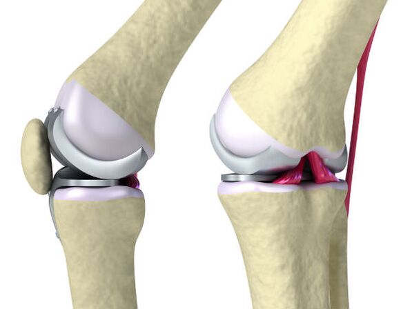 Prótesis de la articulación de la rodilla