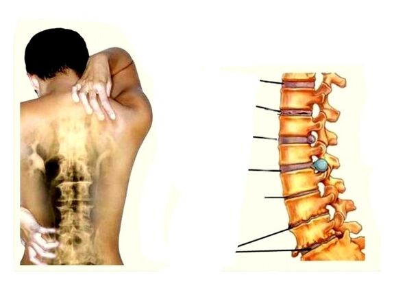 Etapas de desarrollo de la osteocondrosis