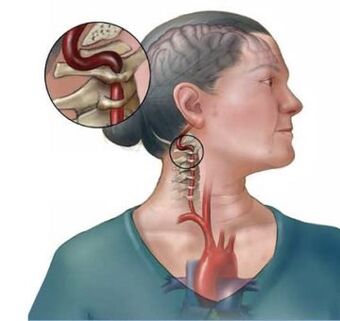 La osteocondrosis cervical conduce a la destrucción de los discos intervertebrales de la columna vertebral