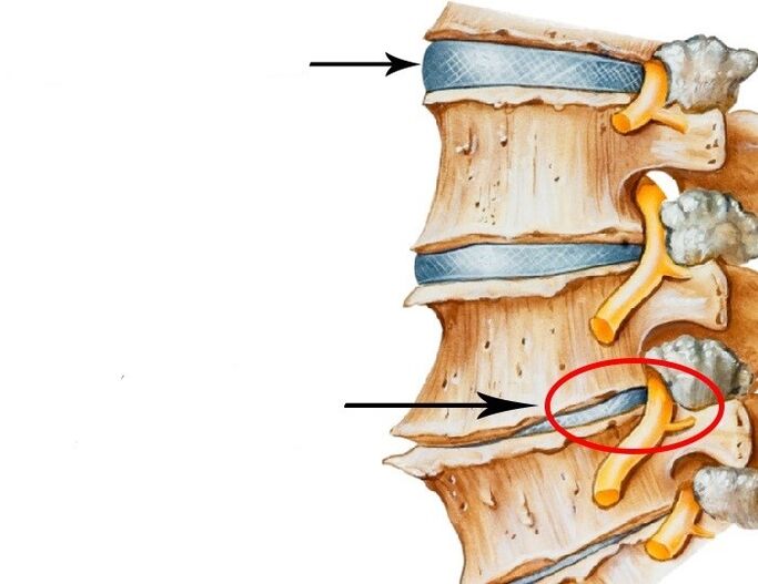 disco dañado y nervio infringido con osteocondrosis cervical