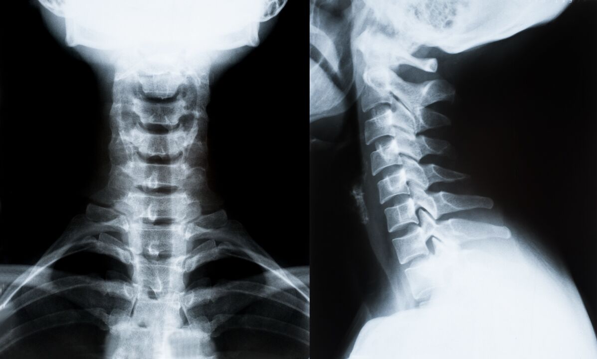 osteocondrosis cervical en radiografía