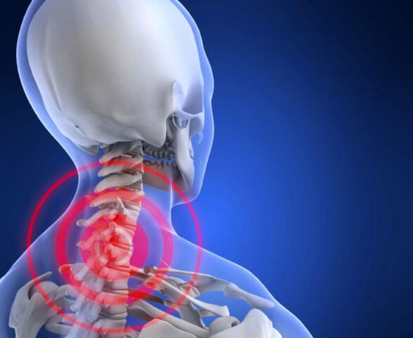 osteocondrosis de la columna cervical